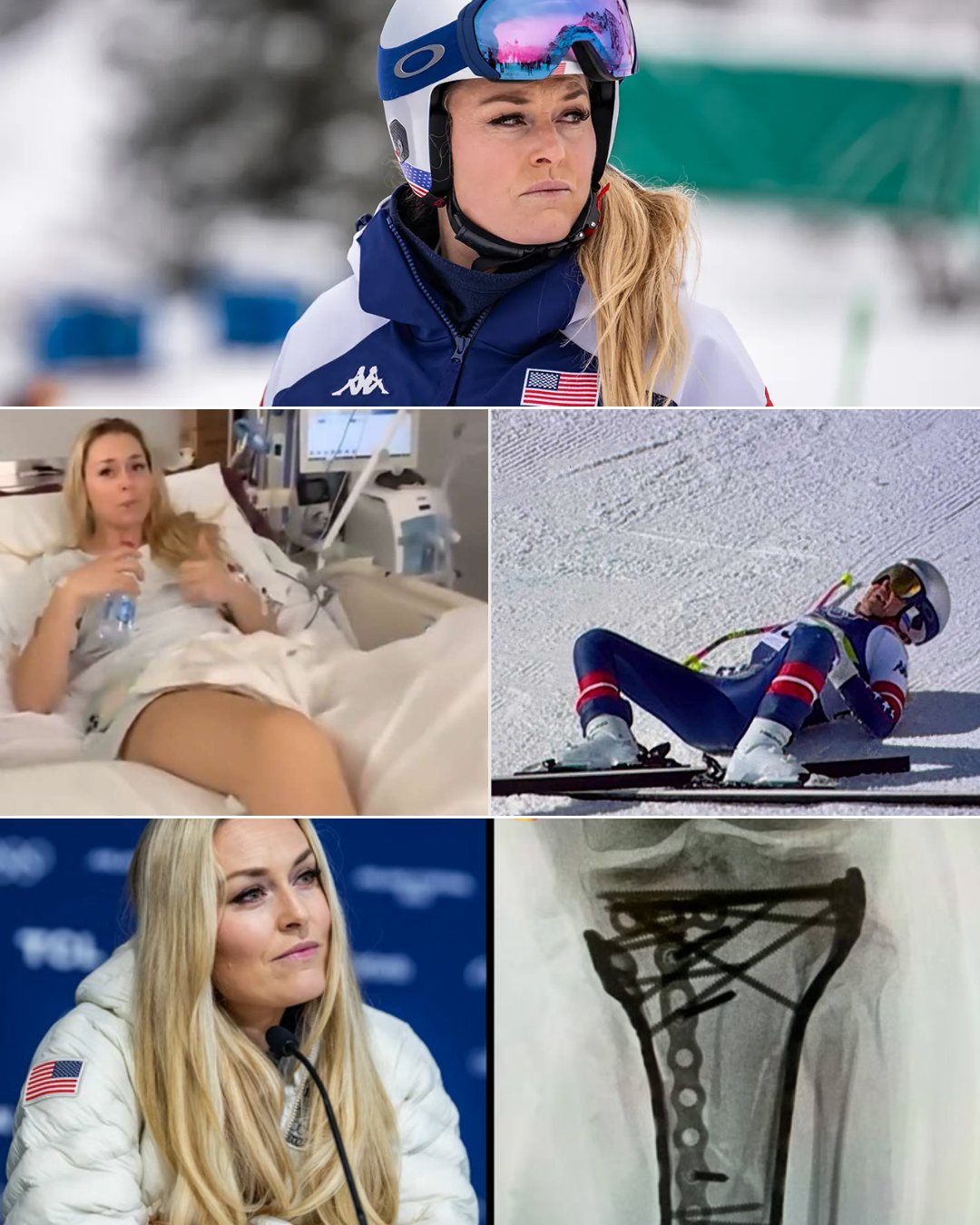 Lindsey Vonnโs latest condition has been revealed after undergoing a fifth operation related to her Olympic crash injuries