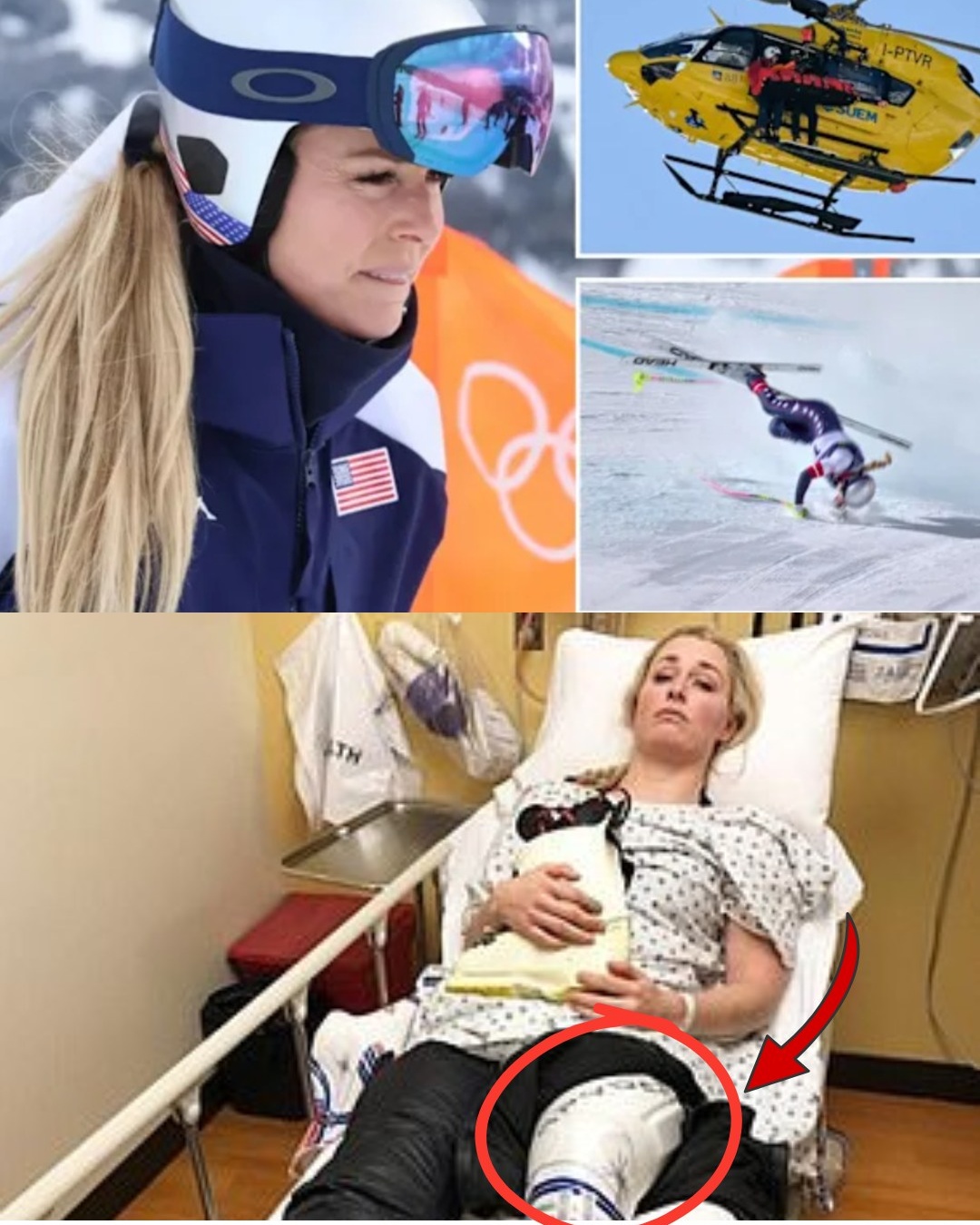 Lindsey Vonn has just broken her silence after her Olympic fall, revealing a shocking truth: her anterior cruciate ligament (ACL) tear was actually pre-existing. Despite knowing the risks, she chose to compete to the best of her ability without hesitation.